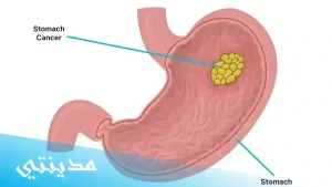 اعراض سرطان المعدة والمريء ، الاسباب و جميع التفاصيل