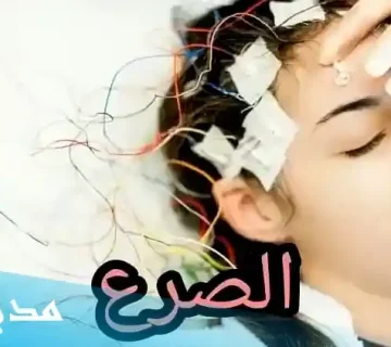 مرض الصرع عند البنات تعرف على جميع التفاصيل