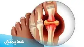 ما هو النقرس gout meaning ؟ الاعراض ، اسباب ، علاج - جميع التفاصيل