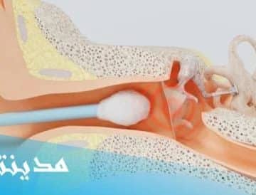 علاج ثقب الاذن عند الاطفال ، الاسباب - جميع التفاصيل